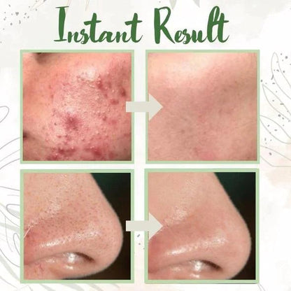 🔥LAST DAY 49% OFF-✨Green Tea Deep Cleanse Mask